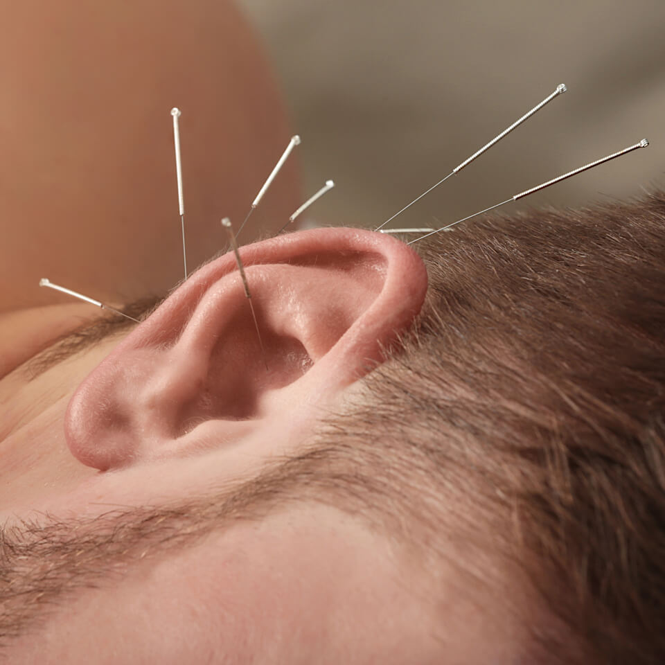 Acupuncture